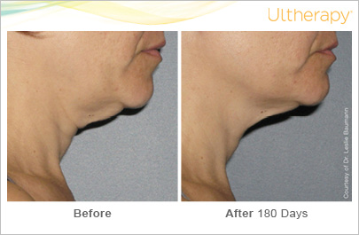 Ultherapy on the neck