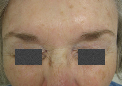 After - Treatment of Scowl Lines (Eleven Lines)