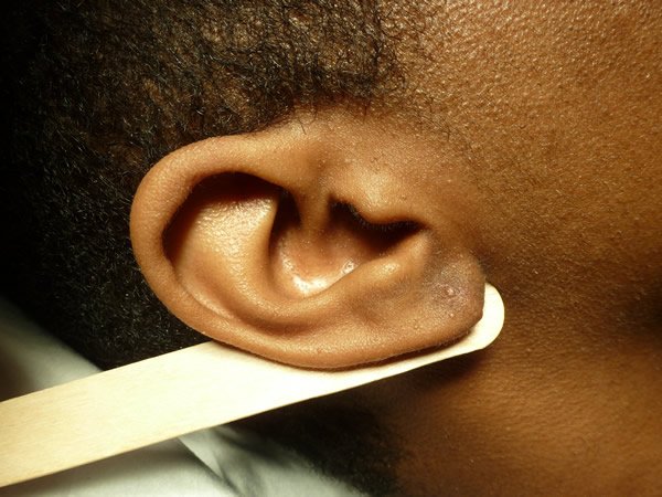 ear-lobe-repair-2-after