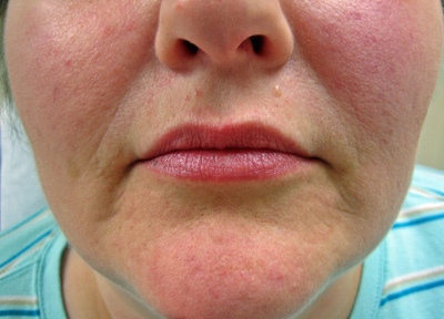 restylane-mouth-before