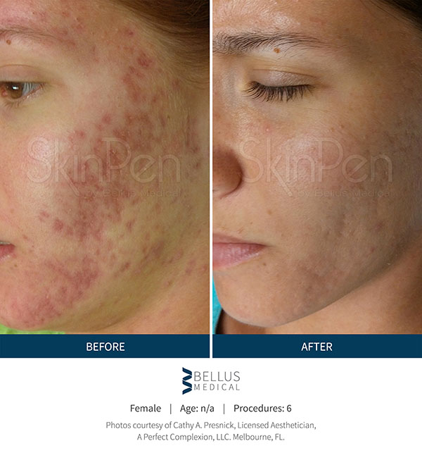 Microneedling Skin Pen Before and After
