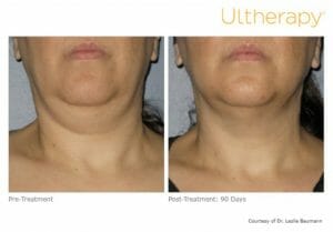 Ultherapy in 90 days
