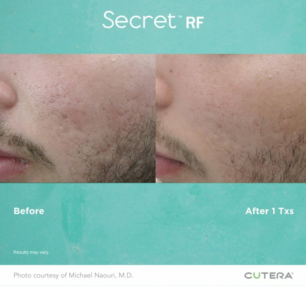 Secret RF Microneedling Before and After